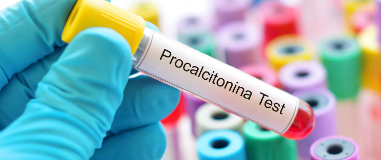 Procalcitonina PCT: la chiave per diagnosticare e monitorare la sepsi