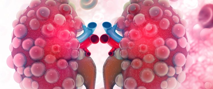 Danno renale: la microalbuminuria e la ferritina come indicatori precoci