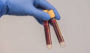 Prelievi e analisi: come prepararsi correttamente